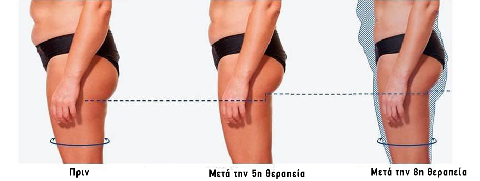 before-after-tx-ems-body-sculpt